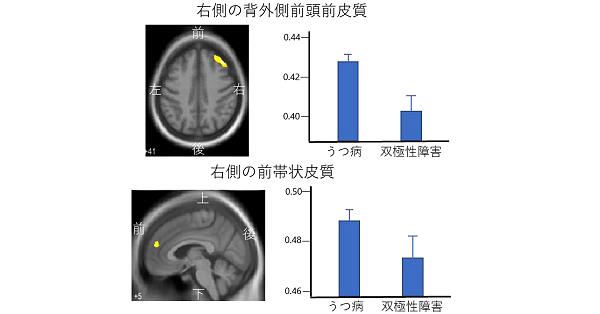 双極性感情障害　脳